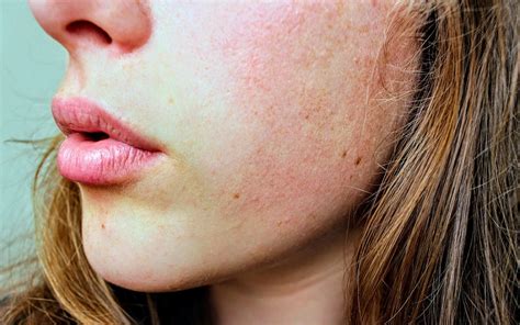 Six Natural Home Remedies To Treat Itchy And Dry Skin