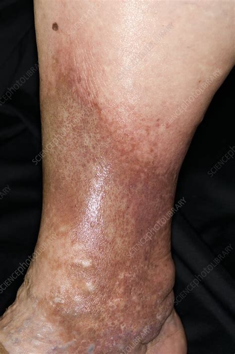 Pigmentation And Varicose Eczema Stock Image C0029563 Science