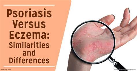 Psoriasis Versus Eczema What S The Difference Zohal