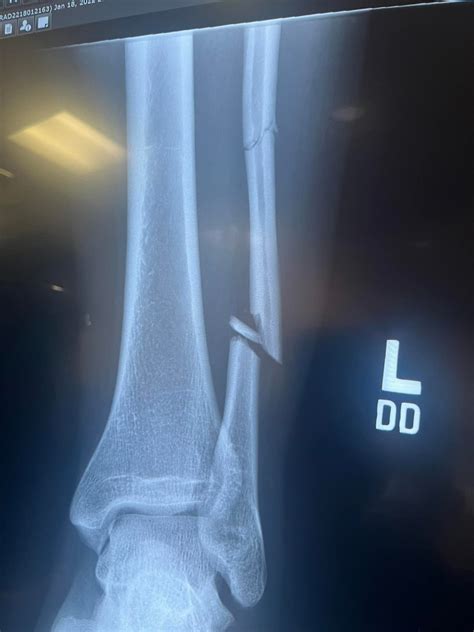 Displaced Fibula Fracture Mixed Information From Doctors Web