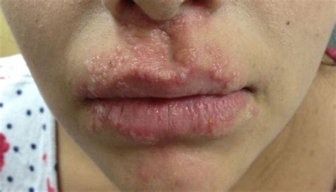 Derm Dx Itchy Lesions Around The Lips Derm Dx Lips Human Mouth