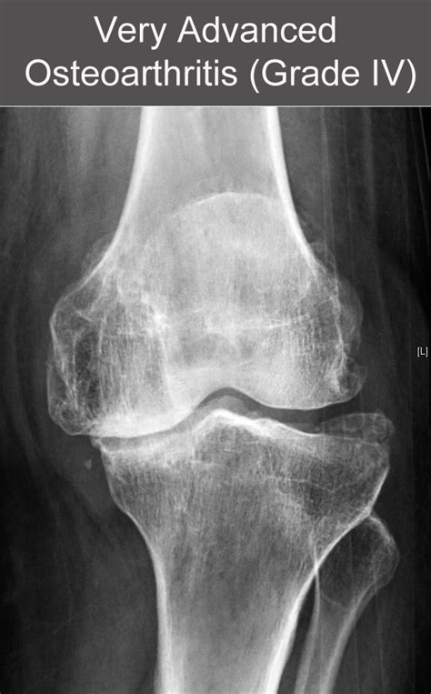 Arthritis Of The Knee Joint Docjointsdr Sujit Josjoint Surgeon