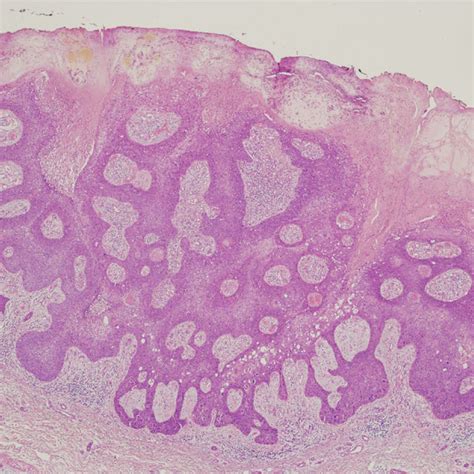 Eccrine Porocarcinoma Composed Of Basaloid Cells With Focal