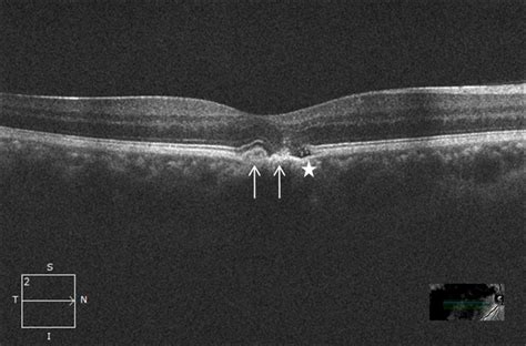 Subfoveal Congenital Hypertrophy Of Retinal Pigment Epithelium Bmj