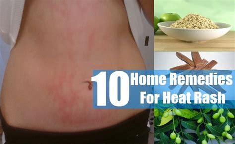 Signs and symptoms of heat rash. 55 best Heat Rash images on Pinterest | Heat rash, Health ...