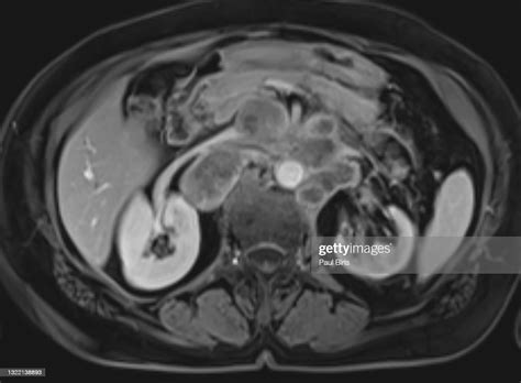 Enlarged Retroperitoneal Lymph Nodes Seen On Mri Magnetic Resonance Image Axial T1