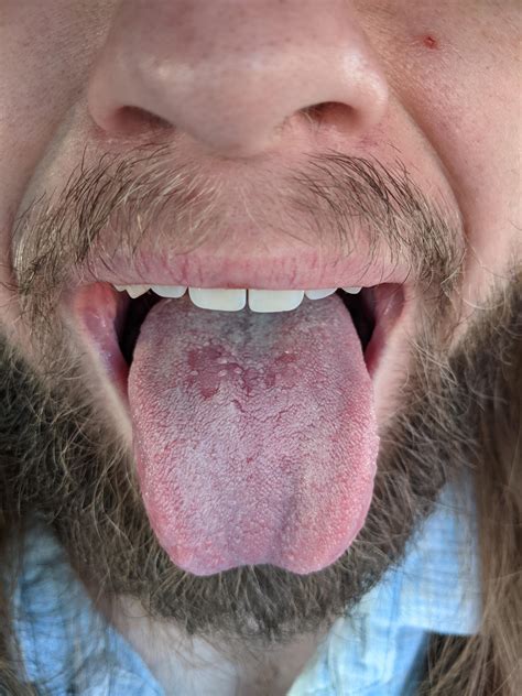 What Is This Bald Red Patch On My Tongue Been Here A Few Months