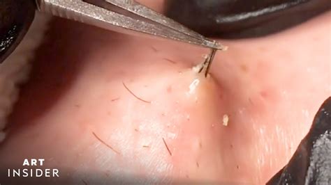 Ingrown Hair Turned Into Hard Lump Under Skin Painful