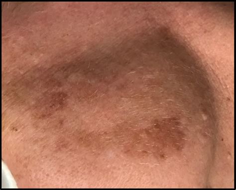 Elysium Skin Laser Agesun Spots