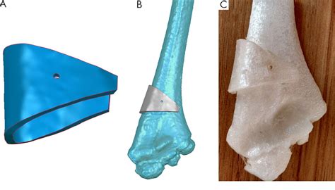 Figure 5 From A Modified Rotating Isosceles Triangle Osteotomy Using A