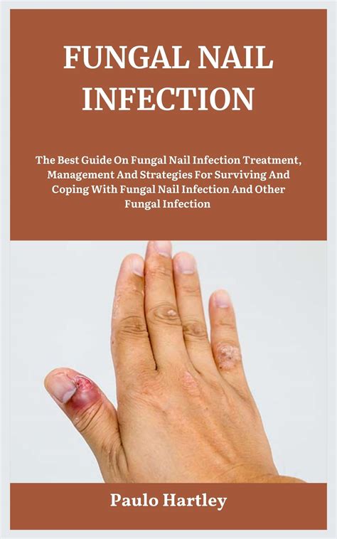 Fungal Nail Infection The Best Guide On Fungal Nail Infection