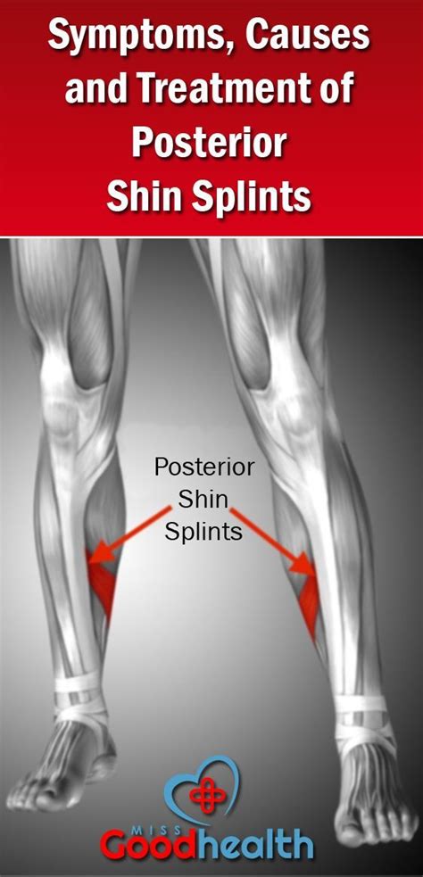 Here Is More Review Of How To Stop Shin Splints Forever By Gary