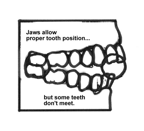 Open Bite Orthodontics San Pedro Eric Kardovich Dmd