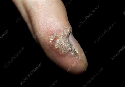 Common Warts Stock Image C0024049 Science Photo Library
