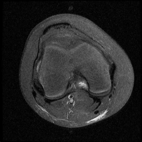 Osgood Schlatter Disease Image