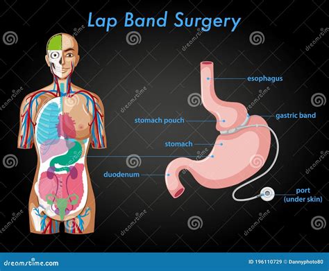 Lap Band Surgery Anatomy Stock Vector Illustration Of Living 196110729