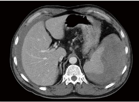 Abdominal Ct Scan Showing A Splenic Subcapsular Haematoma