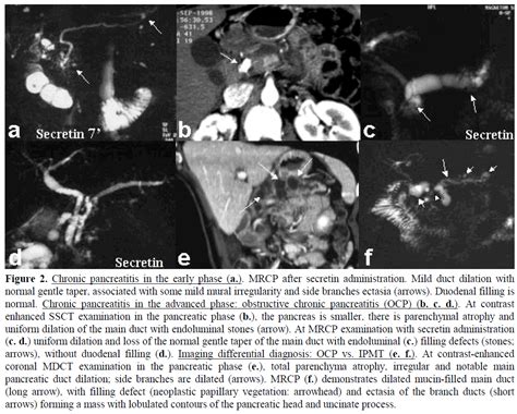 The Various Imaging Aspects Of Chronic Pancreatitis