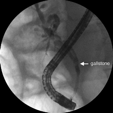 Cannulation Attempt Through The Biliary Access By Use Of Guidewire