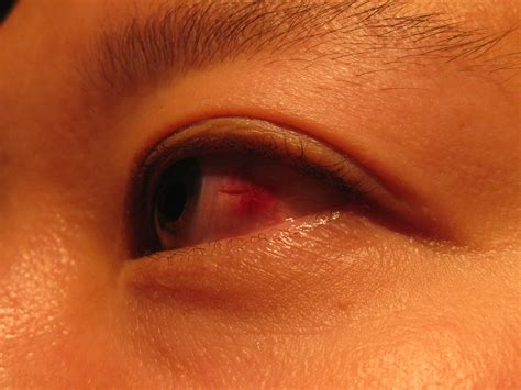Scleral Laceration