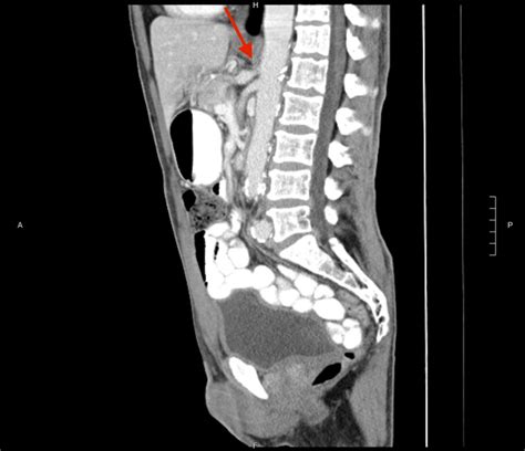 Cureus Median Arcuate Ligament Syndrome