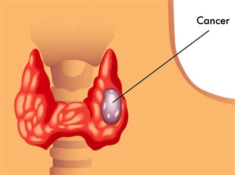 Thyroid Cancer: A Comprehensive Guide and The Top 6 Ways To Prevent It ...