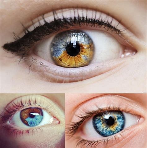 Laser Treatment For Heterochromia Causes Of Heterochromia