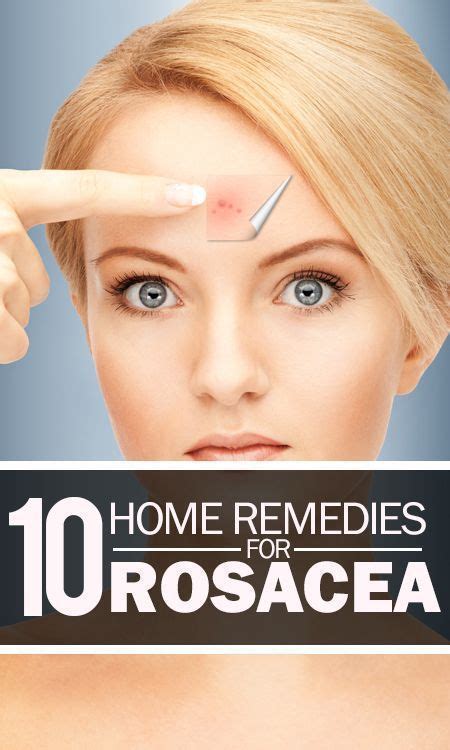 10 Home Remedies For Rosacea That Are Very Effective Home Remedies