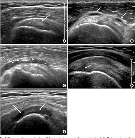 Figure 1 From Sonography Of Affected And Unaffected Shoulders In