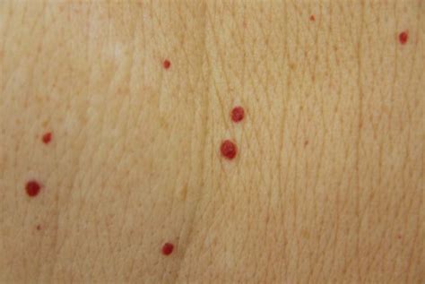 In case you have a large cherry angioma, it might take you few times before you get rid of it. Cherry Angioma in Adults - Removal, Pictures, Treatment ...