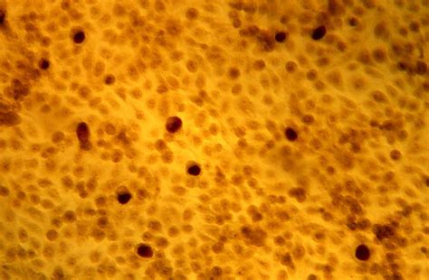 Chlamydia infection photographs are intended for educational purposes & appropriate only for adults. Chlamydia vaccine is on the horizon