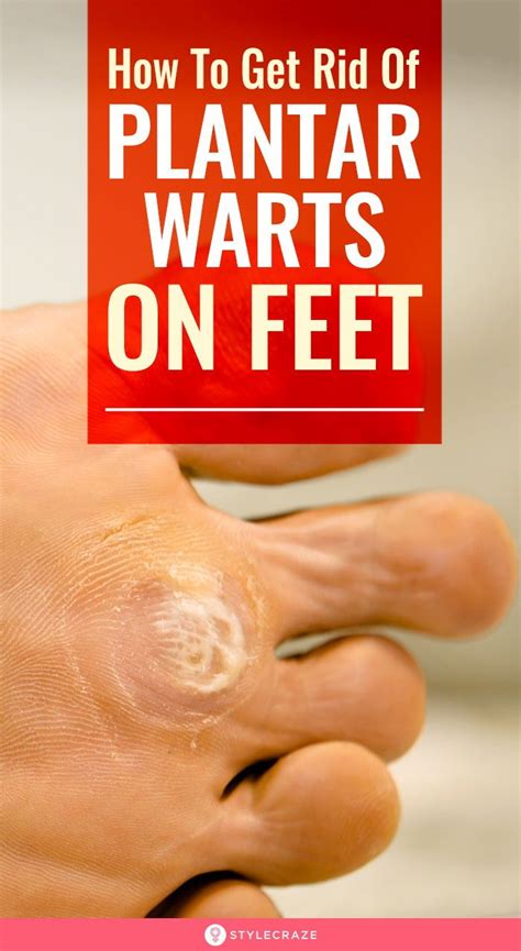 How To Get Rid Of Plantar Warts On Feet Naturally Warts Remedy