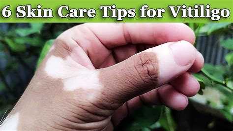 6 Skin Care Tips For Vitiligo Patients Youtube