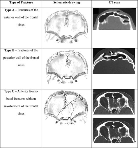anterior cranial fossa fracture