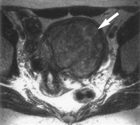Uterine Leiomyomas Histopathologic Features Mr Imaging Findings