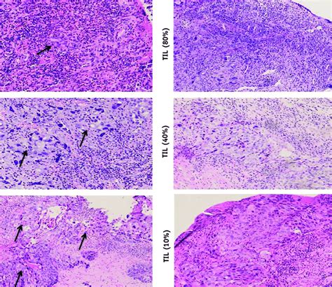 Histopathologic Response Of Esophageal Squamous Cell Carcinoma Tissues