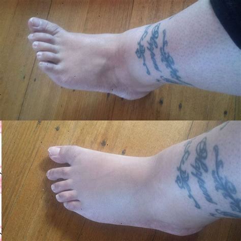 13 Symptoms Of Fibromyalgia — As Shown In Photos Swollen Feet Remedy