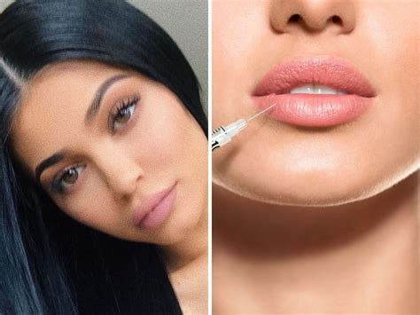 Lip Fillers From Procedure To Risks All You Need To Know About Lip