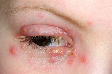 Herpes Infection Of The Eyelid Stock Image C0139706 Science