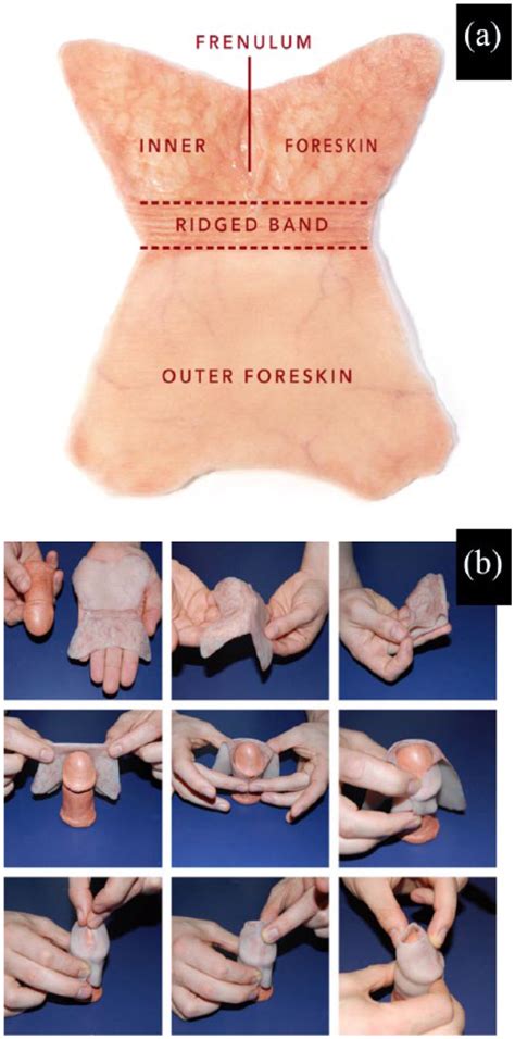 The Human Foreskin Shape After Surgical Removal A Schematic