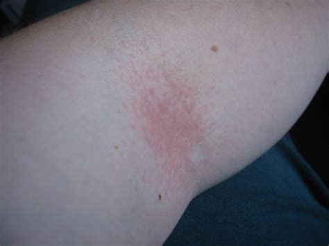 Itchy Rash On Elbows And Chest Pain How To Get Rid Of White Spot On