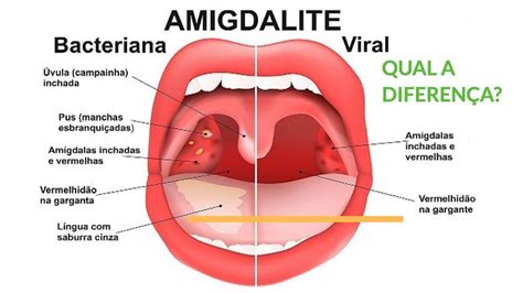 DoenÇas Da Amigdala Amigdalite Aguda Viral Ou Amigdlite Bacteriana