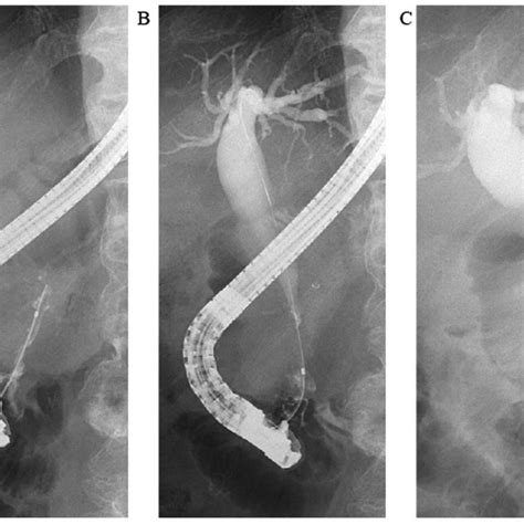 Endoscopic Retrograde Cholangiopancreatography Was Performed To Drain