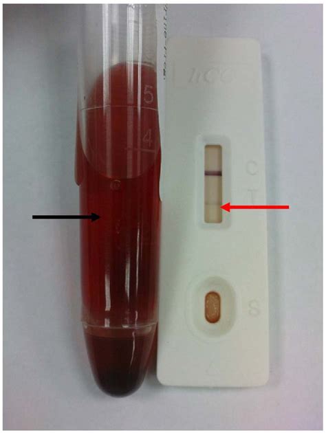 Figure 1 From False Positive Urine Pregnancy Test In A Woman With