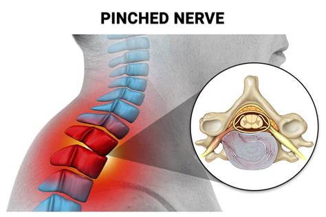 8 Top Warning Signs You Have A Pinched Nerve Physical Therapists Nyc