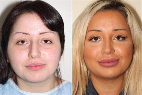 Before And After Rhinoplasty 5 Years Later Dr Denton