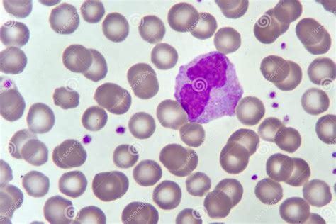 Monocyte Cell In Blood Smear Stock Photo Image Of Anemia Hematology