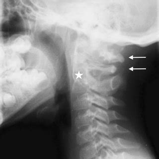 A 41-year-old man with traumatic fractures of T4-T5- T6 ...