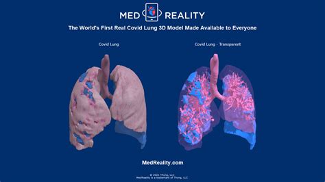 Medreality Releases Covid 19 Lung Model Medreality