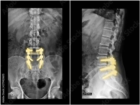 Film X Ray Radiograph Lumbar Spine Showing Spinal Stenosis Treated By